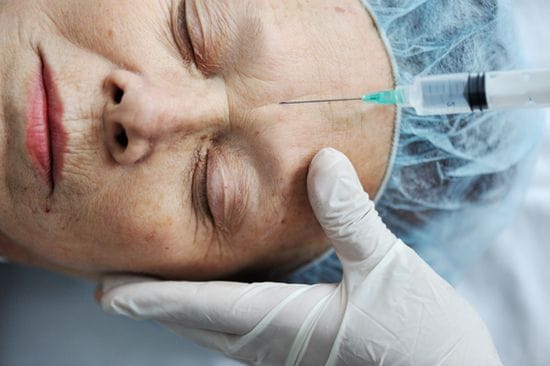 Thread Lift- an Alternative to The Fillers